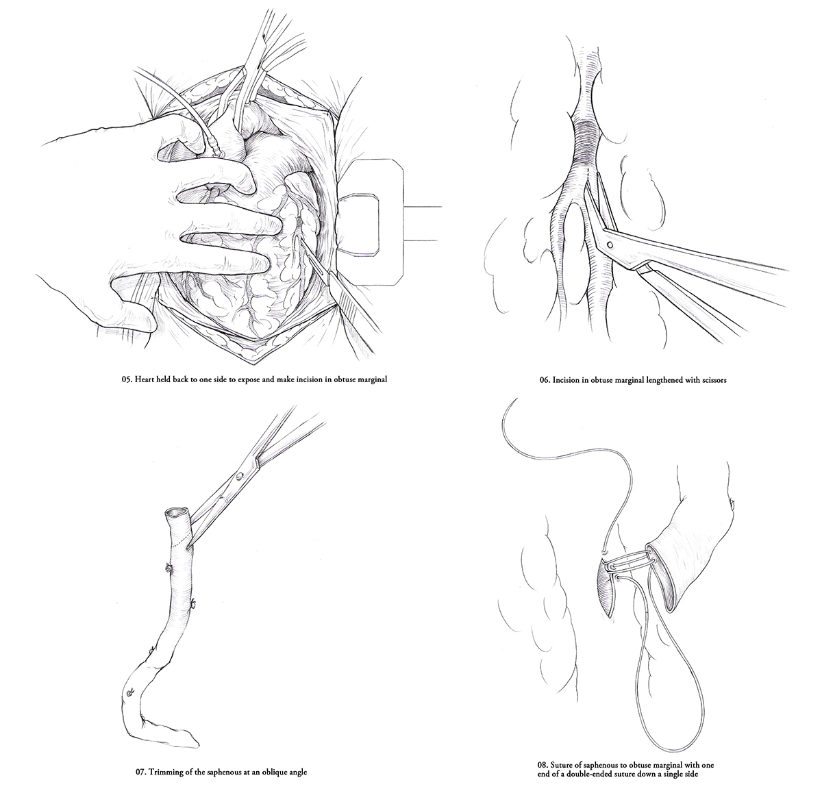Coronary bypass sketches